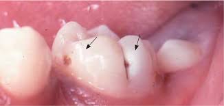 Gum abscess is a type of a dental abscess. Dental Problems In Primary Care American Family Physician