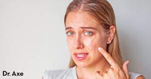 nodular acne symptoms causes