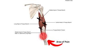 triceps tendonitis a helpful guide for
