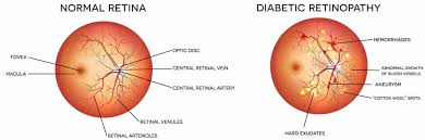 Diabetic Retinopathy Elkhart Diabetes South Bend Eye