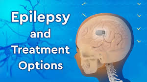 epilepsy in children children s