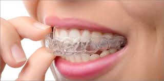 Sports Mouth Guards & Nightguards, Grimsby - Dr. Bina Thomas Dental Clinic