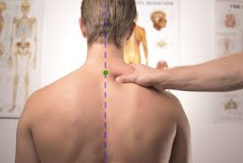 herniated disc with acupuncture tcm