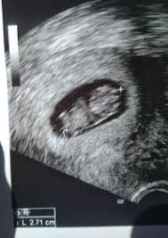 Ssw beginnt nun die fetalperiode. Ultraschall Ssw 9 2 Forum Schwangerschaft Urbia De