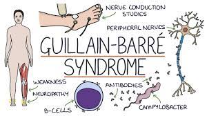 Luckily, most people who get gbs . Understanding Guillain Barre Syndrome Youtube