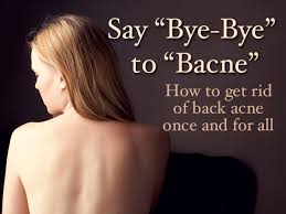 say bye bye to bacne back acne
