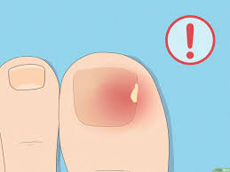 remove and care for dead toenails