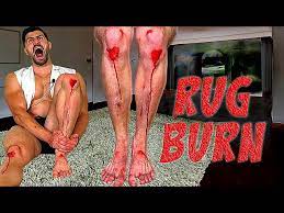creating the worst rug burn injury of