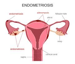 A condition, usually resulting in pain and dysmenorrhea, that is characterized by the abnormal occurrence of functional endometrial tissue. What Is Endometriosis Indian Center For Endometriosis Ice
