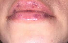 white spots on lip after juvederm photo