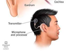 Image of Cochlear implant