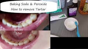 Here are few ways of using baking soda to get rid of plaque and tartar. How To Get Rid Of Tartar Aerica Lee Youtube