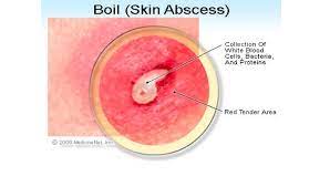 abscesses and boils 7 best