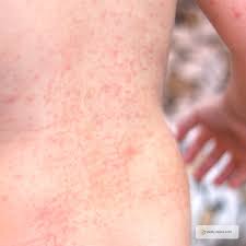 natural remes for heat rash in children