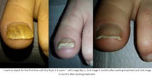 nail fungus treatment nail infection