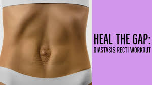 Diastasis recti is a condition of the abdominal muscles that can occur after pregnancy. Heal The Gap Diastasis Recti Workout Diary Of A Fit Mommy