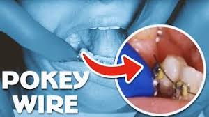how to cut pokey braces wire at home