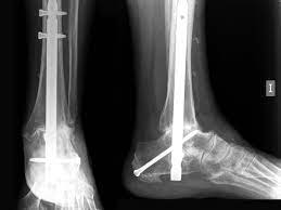 arthroscopic ankle and subtalar
