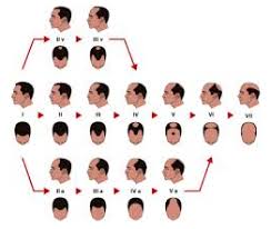 The Psychological Effects Of Hair Loss On Men His Hair Clinic
