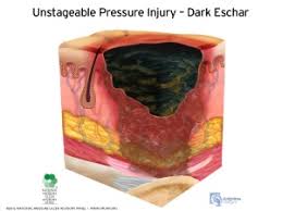 pressure ulcers physiopedia