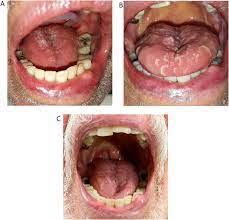 mucosal lesions in a covid 19