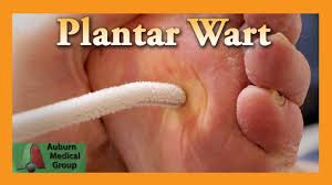 Include full title of the video2. Plantar Wart Treatment Auburn Medical Group Youtube