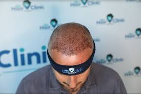 removing scabs after a hair transplant