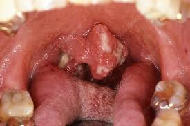 Tonsil cancer, throat examination - Stock Image - M131/0727 - Science Photo  Library