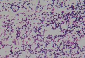 Image of a gram stain prepared from an 18 hour old broth culture. A Case Of Meningoencephalitis Caused By Listeria Monocytogenes In A Healthy Child