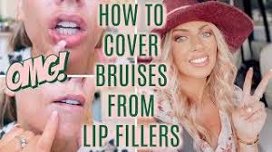 how to cover bruises from lip fillers