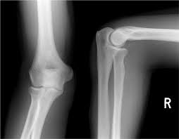 The medial epicondyle of the humerus is an epicondyle of the humerus bone of the upper arm in humans. The Elbow