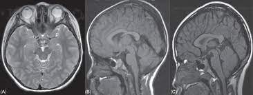 brain magnetic resonance imaging mri