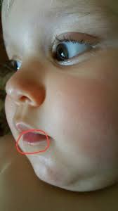 small red dot on lower lip babycenter
