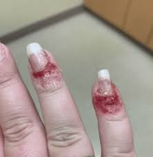 an infection from a dip powder manicure