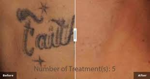laser tattoo removal less pain no