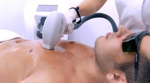 permanent hair removal laser benefits