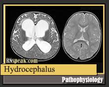 Hydrocephalus Pathophysiology And Schematic Diagram