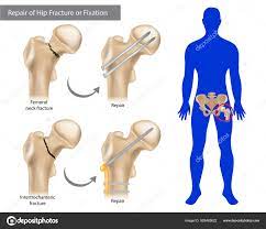 repair hip fracture fixation