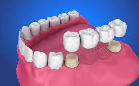 how much do dental bridges cost