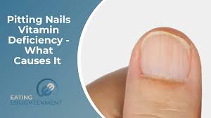 pitting nails vitamin deficiency what