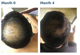 minoxidil shedding increased hair fall