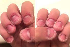 skin around your finger nails