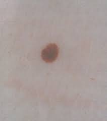 It might look like a skin rash at first, but the cancer. Melanoma Symptoms Treatment And Prevention Live Science