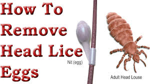 how to remove head lice eggs ह ड ज