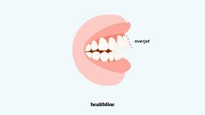 It's often called 'overbite' although this is not the correct term and an orthodontist would always use the term, overjet. Overbite Braces Best Options Alternative Treatments