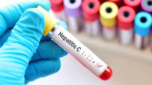 Hepatitis C: Ansteckung und ...