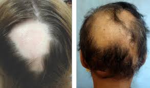 hair transplant for alopecia areata