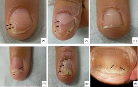 clinical features and nail clippings in