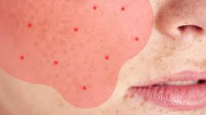 acne might actually be rosacea