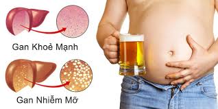 Uống rượu bia quá nhiều:sẽ làm tăng gánh nặng cho gan.